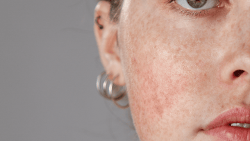 Understanding Rosacea: What It Is, What Triggers It, and How I'd Care for It