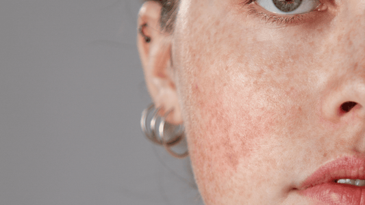 Understanding Rosacea: What It Is, What Triggers It, and How I'd Care for It