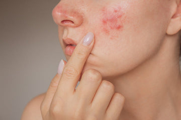 Why Your Skin Is Suddenly So Sensitive (And What To Do)