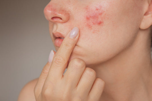 Why Your Skin Is Suddenly So Sensitive (And What To Do)