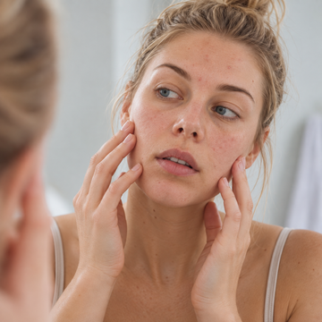 Oily, or dehydrated? A lot of people are both