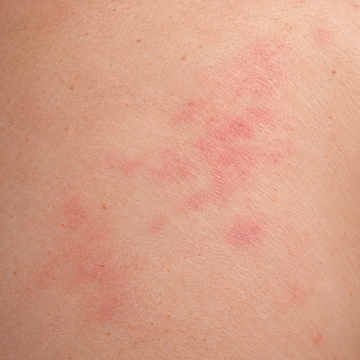 What's actually happening when skin stings